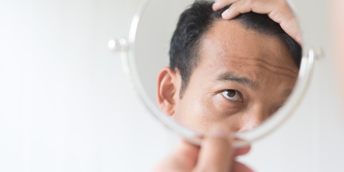 Men are worried about hair loss.