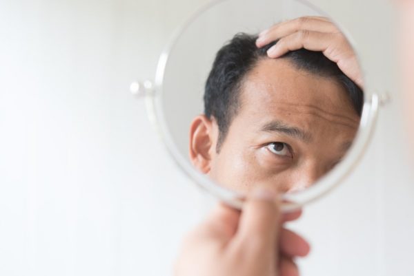 Men are worried about hair loss.
